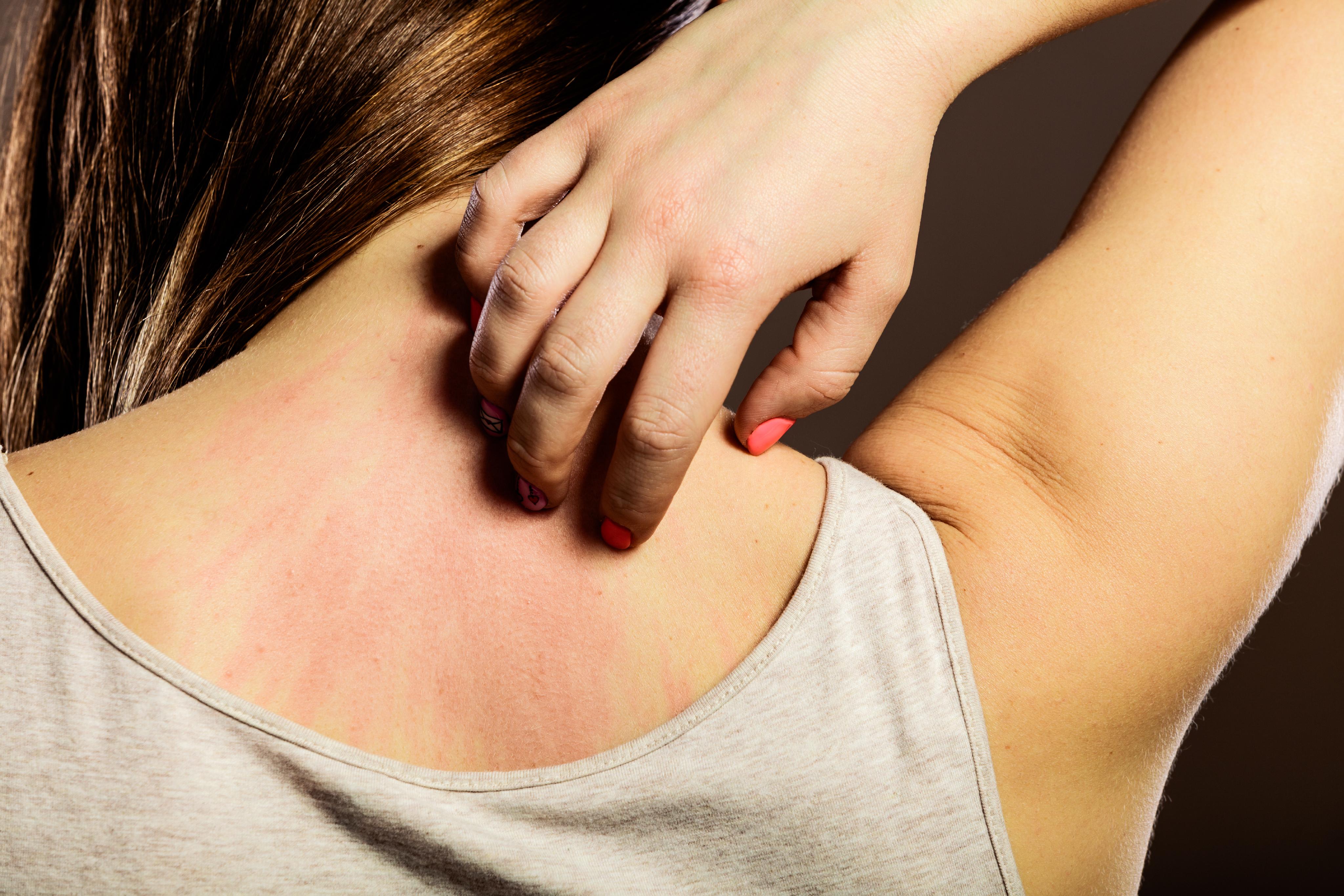 skin disease